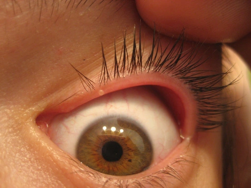 Noveha’s Guide to Navigating Blepharitis